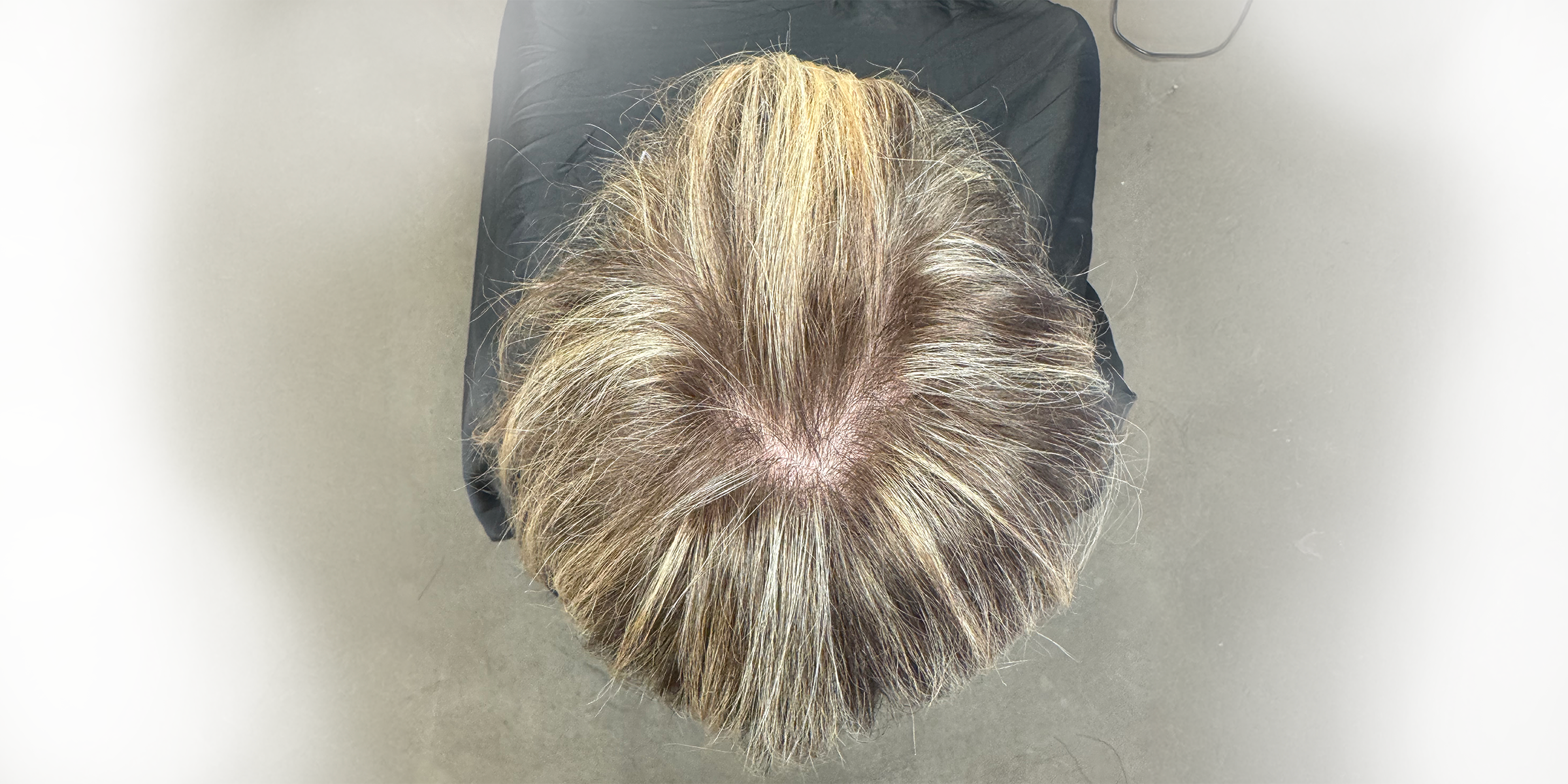LZ_Hair_V-Shaped_Topper-Before